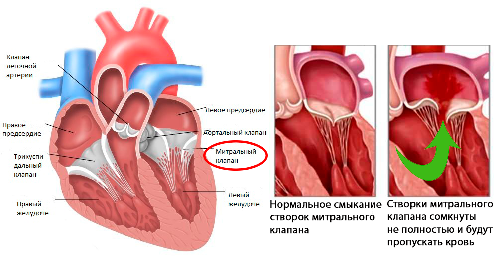 недостаточность митрального клапана недостаточность митрального клапана